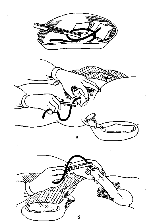 Как ставят катетер в мочевой