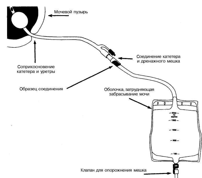 Как ставить катетер в мочевой пузырь женщинам схема